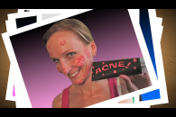 Acne!
