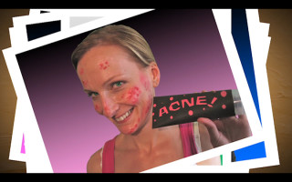 Acne!